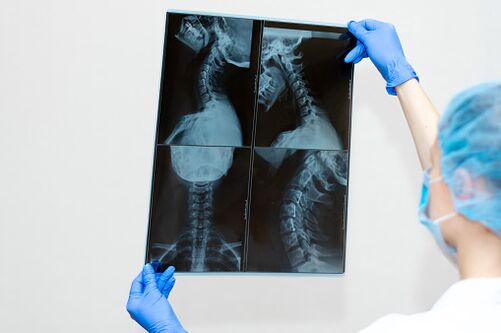Choroba kręgosłupa osteochondrozy