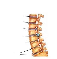 etapy rozwoju osteochondrozy