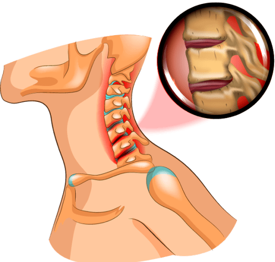 Osteochondroza w szyi